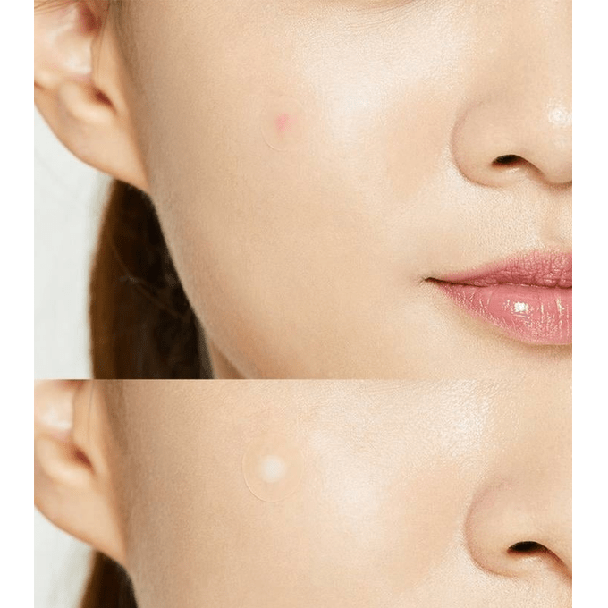 COSRX Acne Pimple Master Patch (24 patches) – Wholesale (100 pcs/carton)